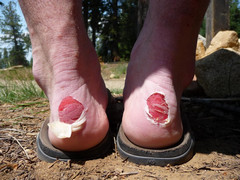 blisters from hiking sandals