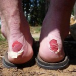 blisters from hiking